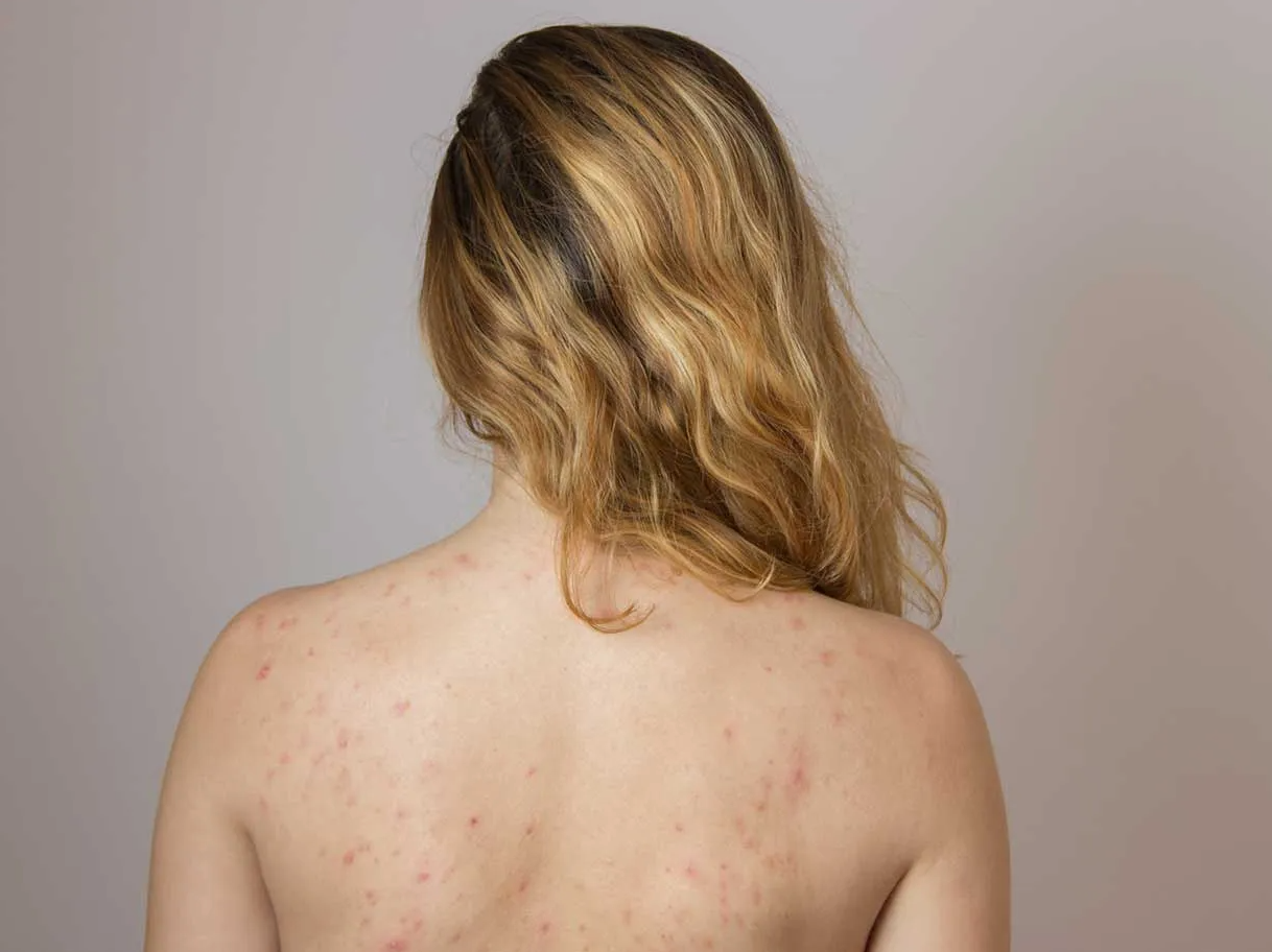 Jaki zabieg na trądzik?